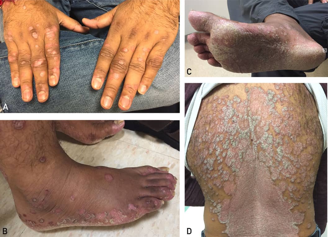 Chikungunya Surge in East Africa: WHO’s Global Alert Sparks Urgent Action