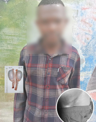 Isabirye and where they removed the testicle (inset)