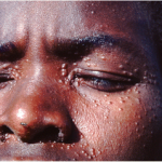 Probe Unearth Rot Under Kala-Azar (PKDL) Vaccine Project at Makerere Funded by European Vaccine Initiative